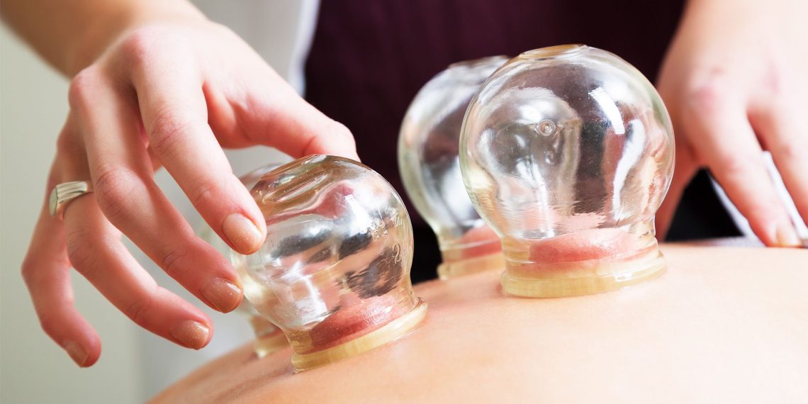Know About The Traditional Chinese Method Of Cupping!